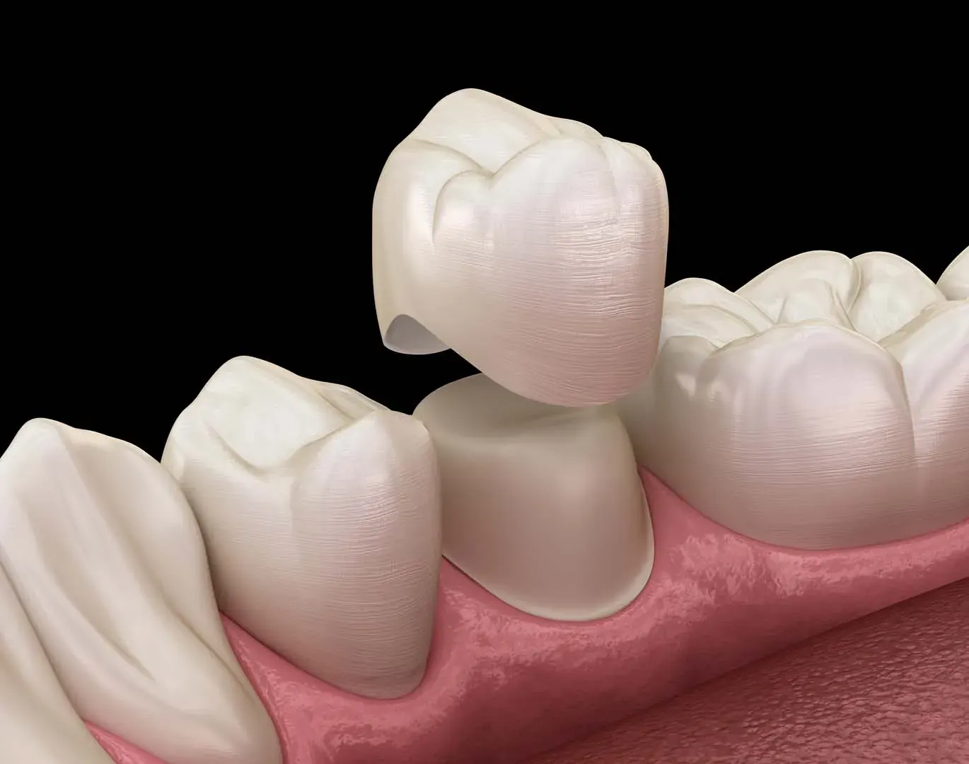 Restorative & Tooth Replacement at Newkirk Dental Center